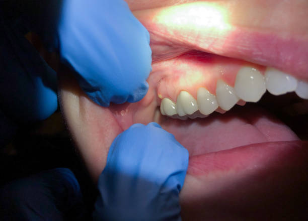 Best Dentist for Tooth Abscess  in Pine Mountain Clu, CA